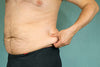 Exercise and Cellulite